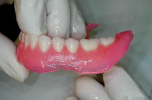 Denture with soft liner directly after impression taking.